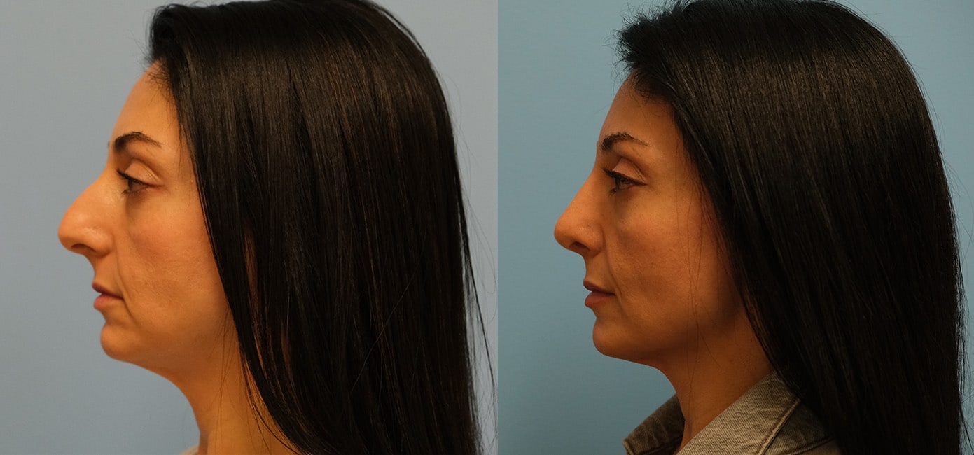 Before and After Image: Rhinoplasty - left-side