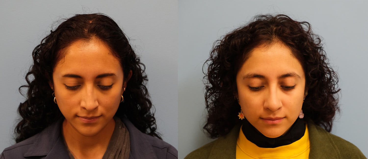Before and After Image: Revision Rhinoplasty - front