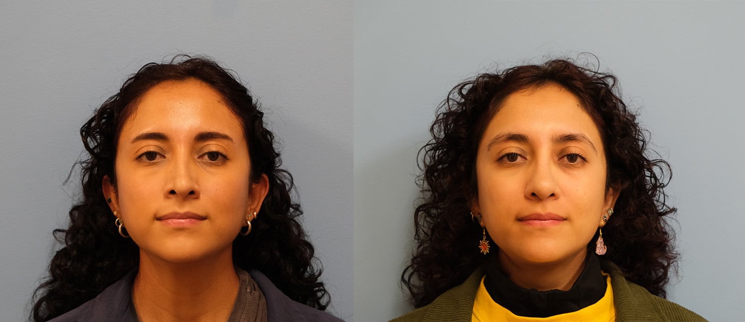Before and After Image: Revision Rhinoplasty - front