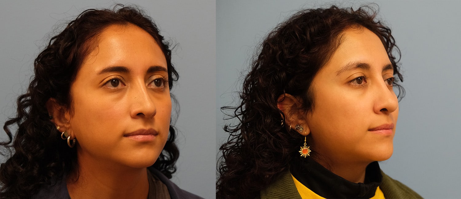 Before and After Image: Revision Rhinoplasty - right-front-oblique