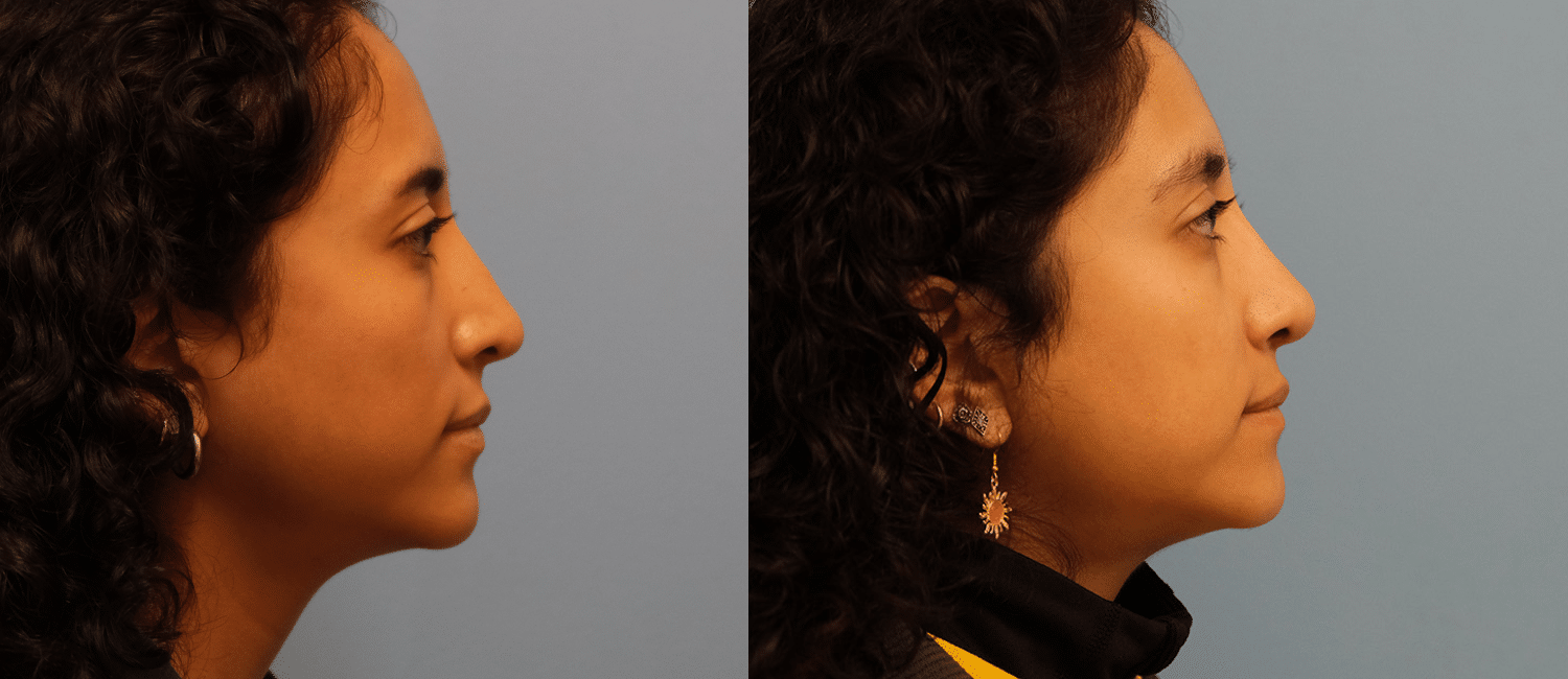 Before and After Image: Revision Rhinoplasty - right-side