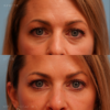 Undereye Fillers